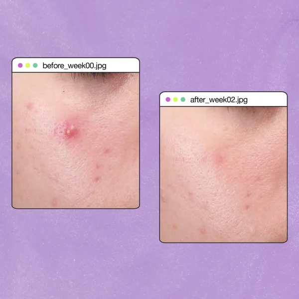 breakout clearing liquid peel - Image 17